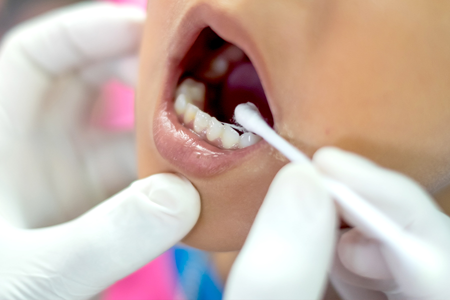 事前の表面麻酔